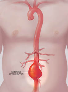 salem-vascular-surgeon-aortic-aneurysm