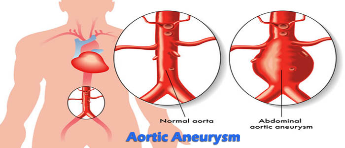 salem-vascular-surgeon-aortic-aneurysm