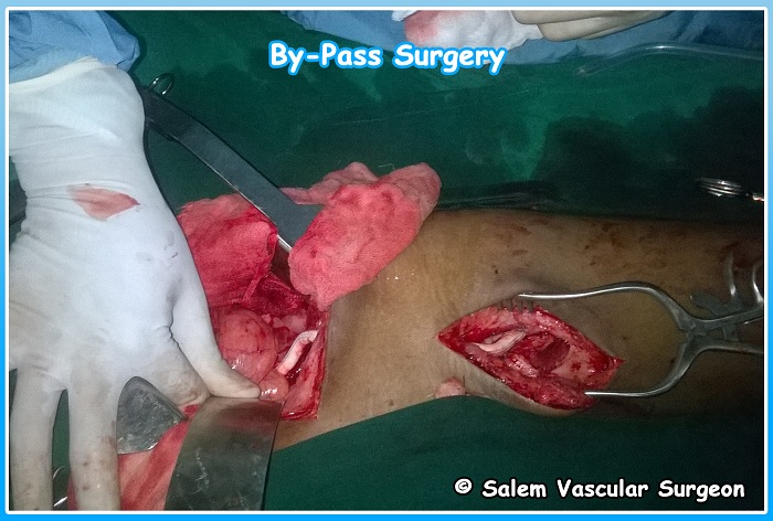 salem-vascular-surgeon-bypass