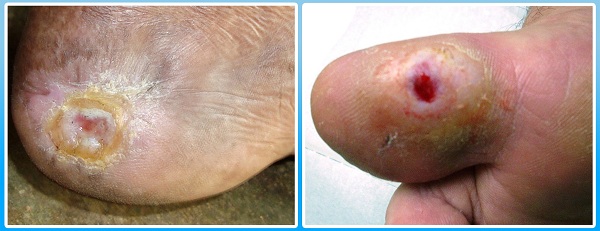 salem-vascular-surgeon-foot-ulcer
