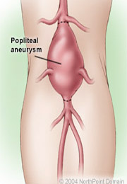 salem-vascular-surgeon-peripheral-aneurysm