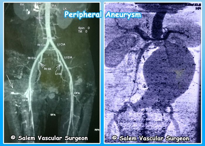 salem-vascular-surgeon-peripheral-aneurysm