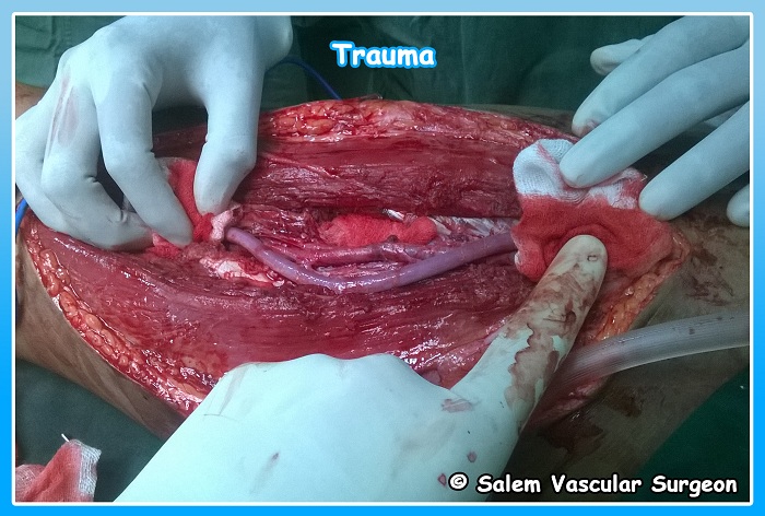 salem-vascular-surgeon-vascular-trauma