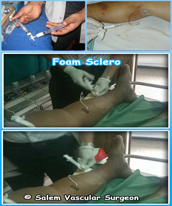 salem-vascular-surgeon-varicose-vein