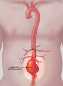 salem-vascular-surgeon-aortic-aneurysm